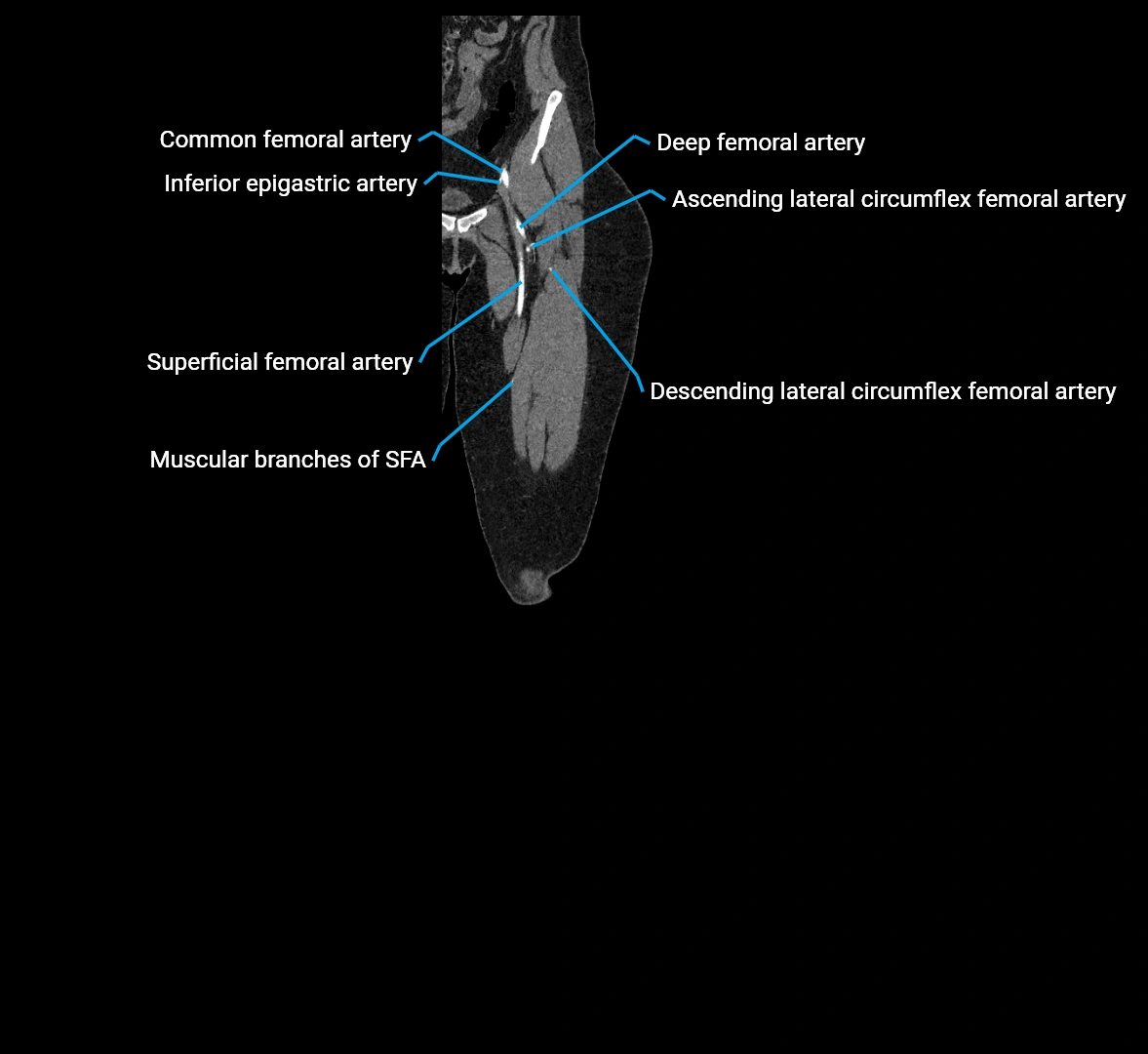 CTA lower limb coronal cross sectional anatomy labelled image _16 (2).webp